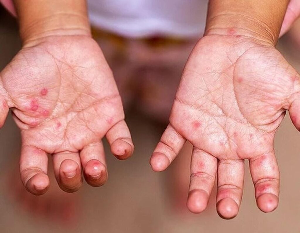 'Hand Foot Mouth' disease is rampant in AP