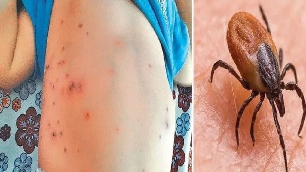 ‘Scrub Typhus’ bacteria causing a stir in the state of AP