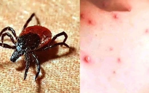 Six-year-old girl tests positive for scrub typhus
